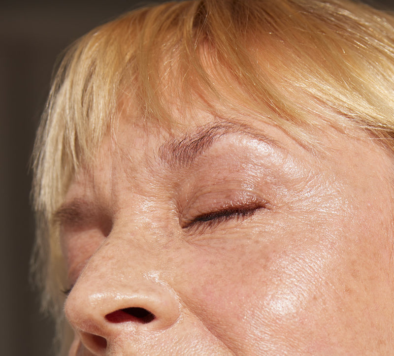 eyelid blepharoplasty