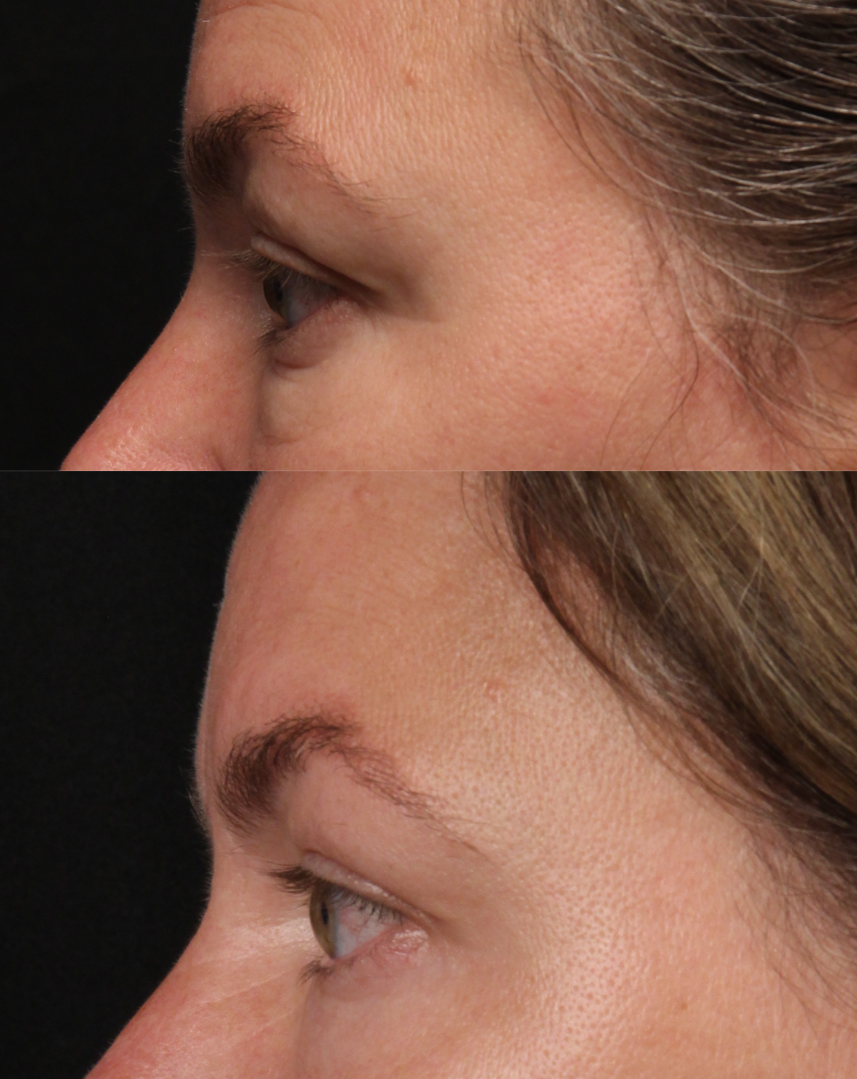 filler for under eye bags