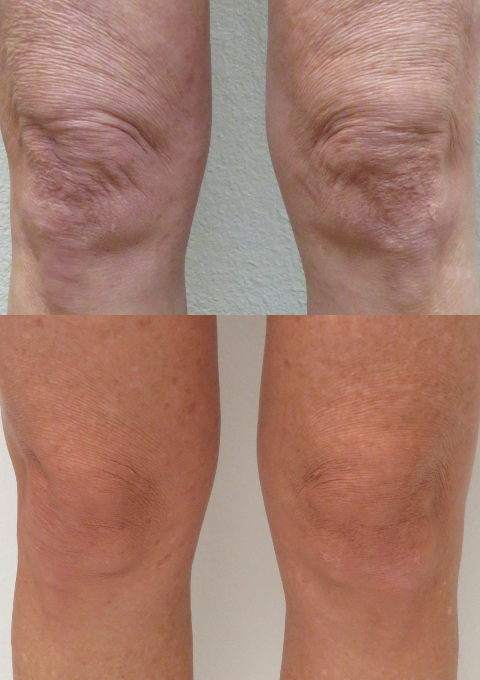 knee rejuvination