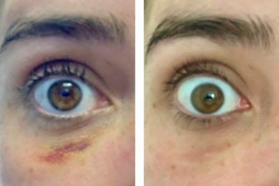 post injection bruise management
