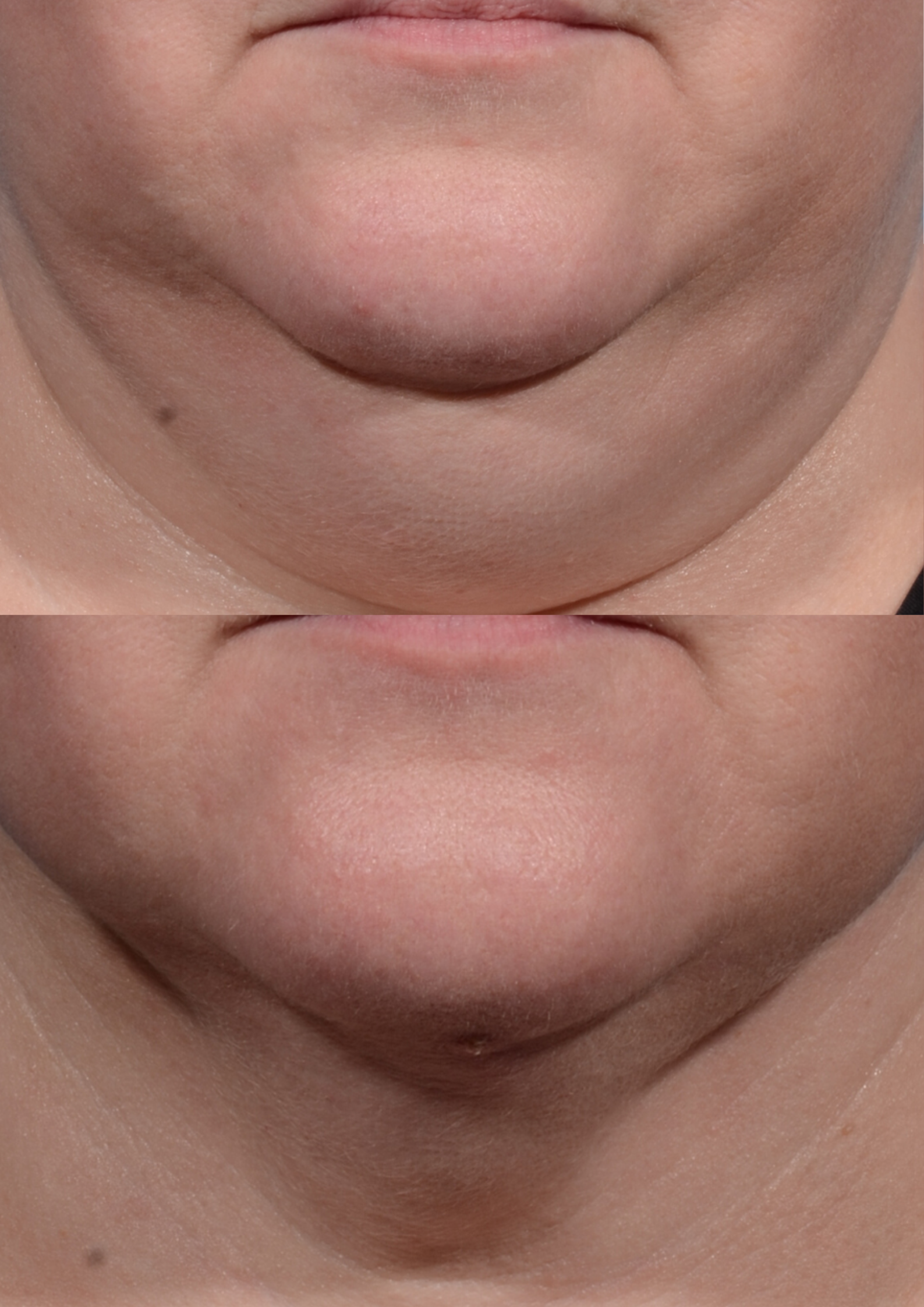 saggy neck treatment