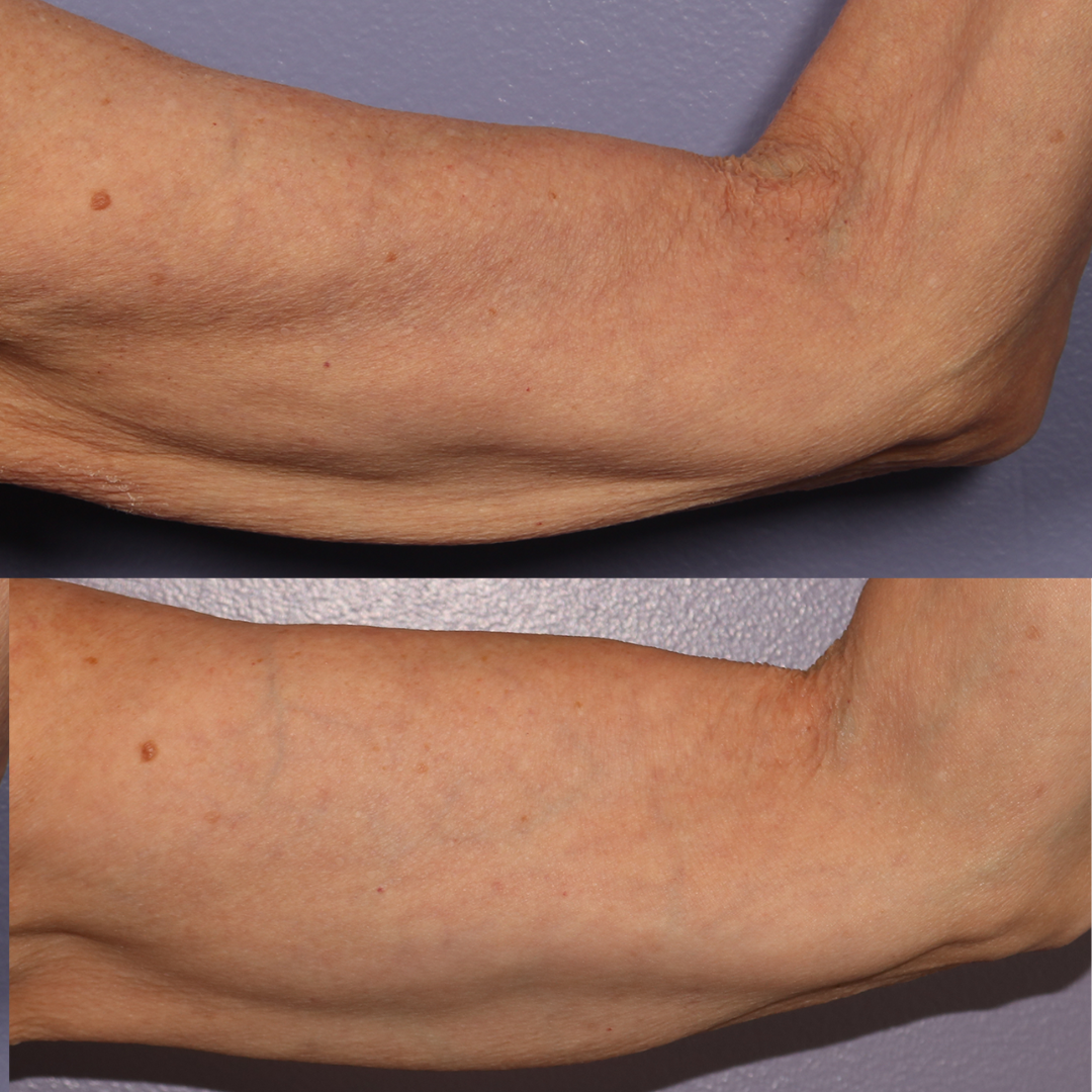best treatment for skin laxity in sydney