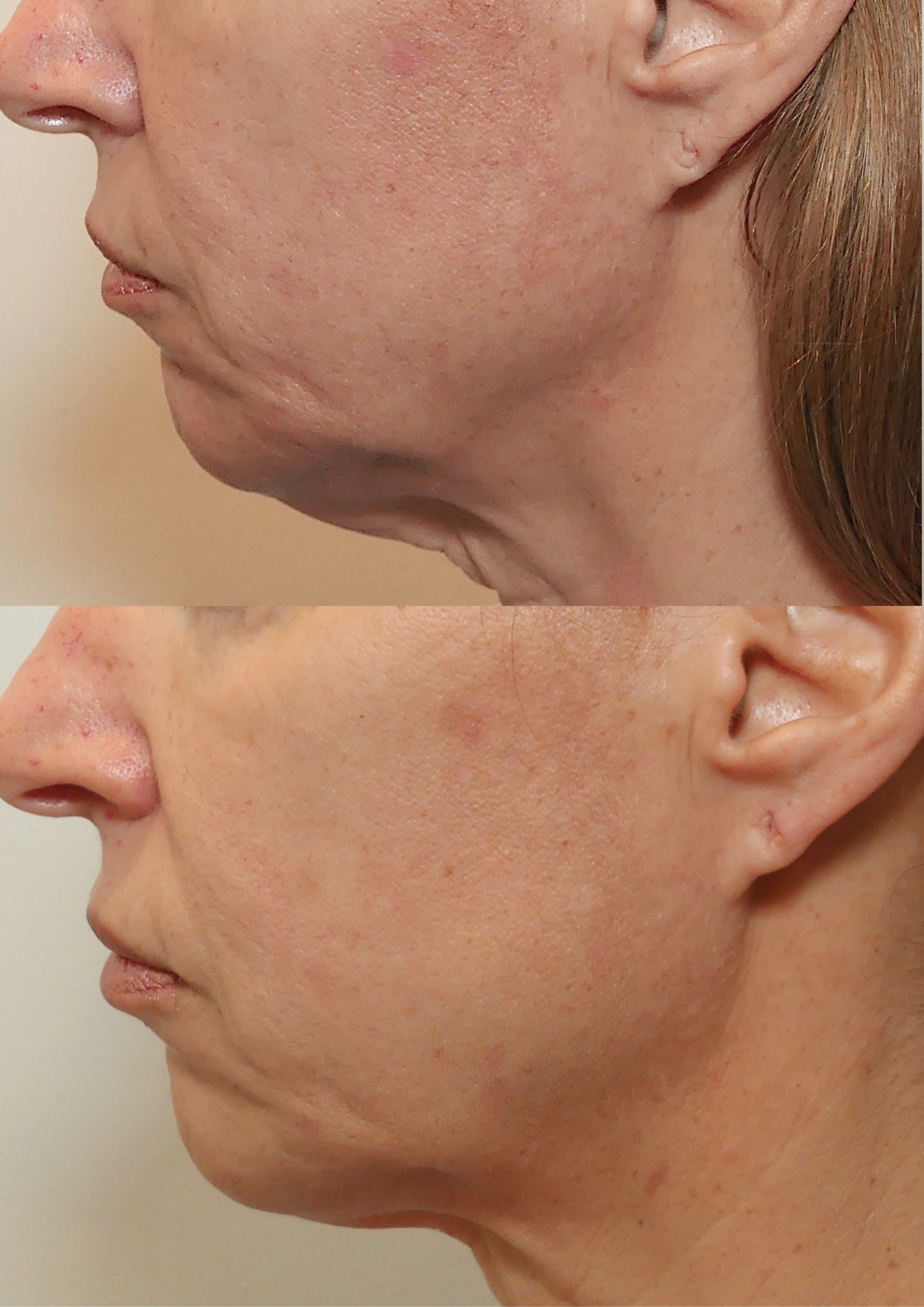 turkey neck treatment in sydney