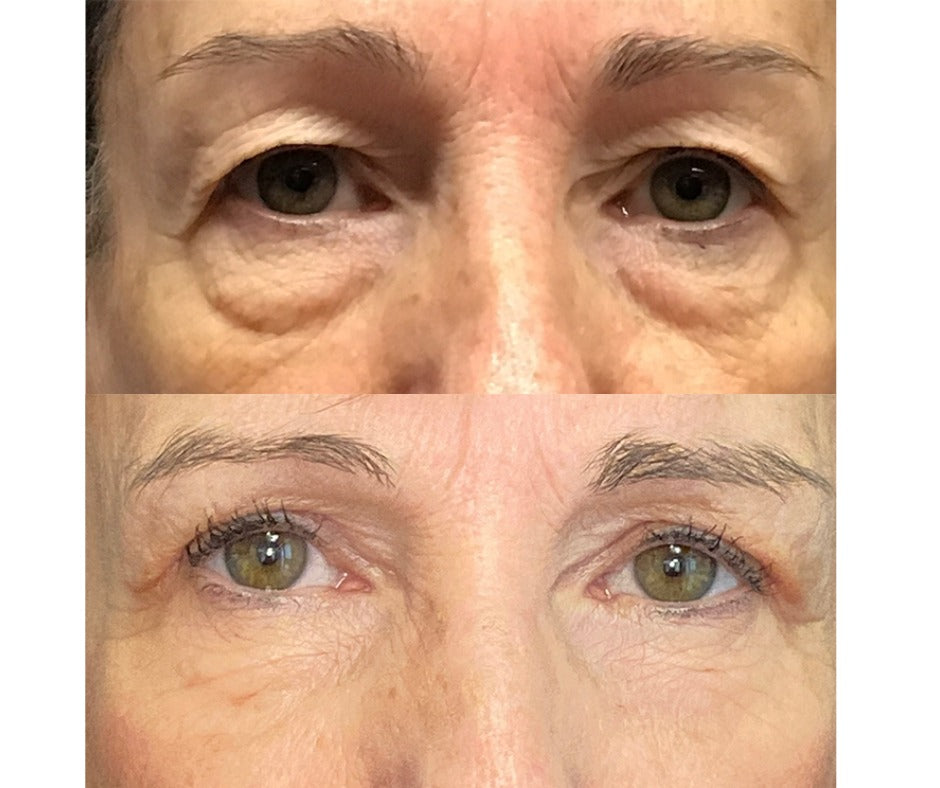 droopy eyelid treatment