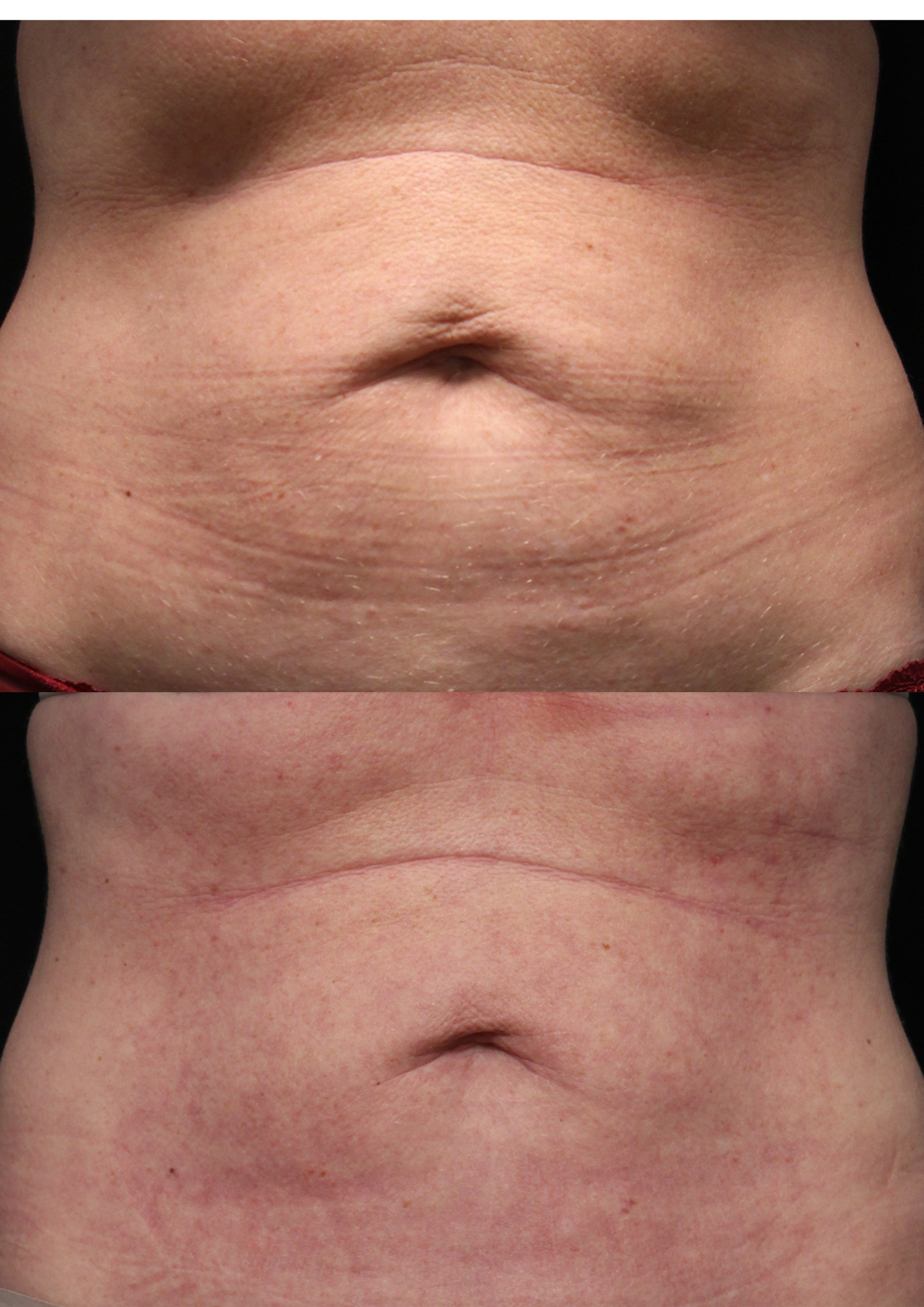 morpheus8 treatment for tummy fat