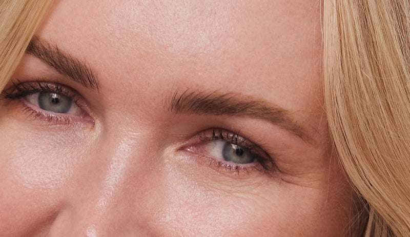 tear trough dermal filler