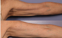 Endolift vs Morpheus8, BodyTite & FaceTite: Which Treatment May Be More Suitable for Skin Tightening and Localised Fat Reduction?