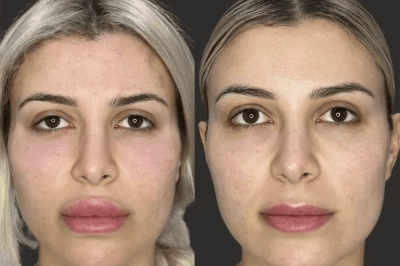 Dissolving Filler: Why You Might Consider Filler Reversal and Correction