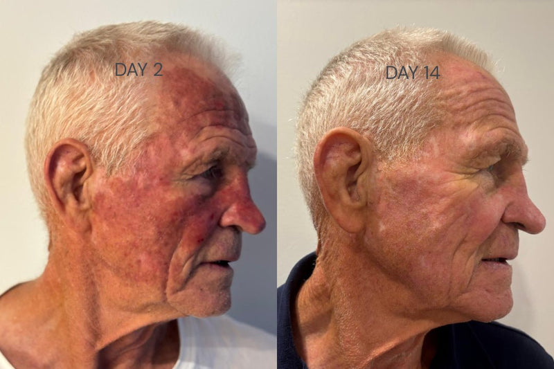 Reducing Skin Cancers with Photodynamic Therapy (PDT) in Bondi Sydney