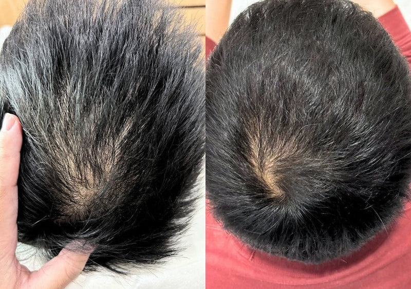 Exosomes for Hair Growth and Grey Hair Reduction in Sydney