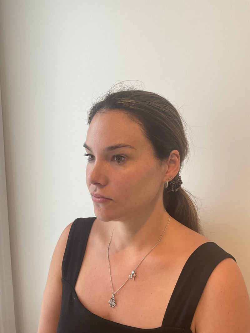 Before 3DMIRACL laser resurfacing for pigmentation and uneven tone
