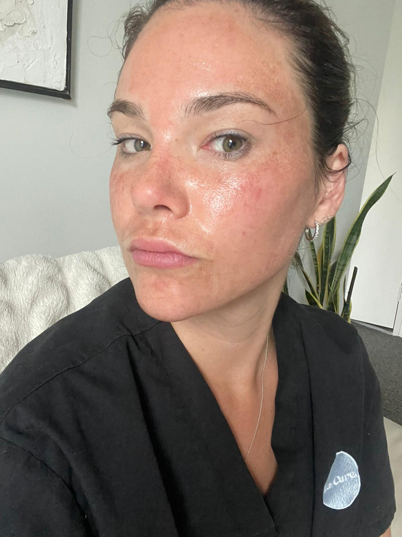 One day after UltraClear 3DMIRACL laser treatment showing redness and pigment darkening