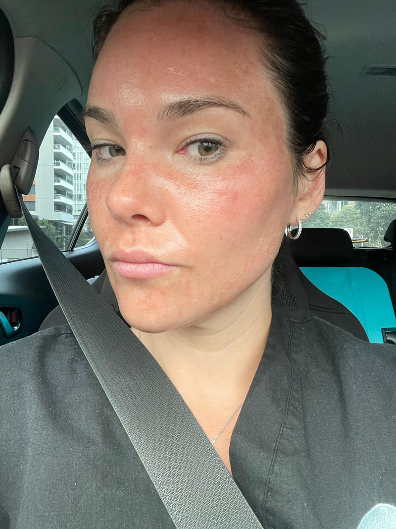 Three days after 3DMIRACL laser resurfacing showing bronzing and light flaking