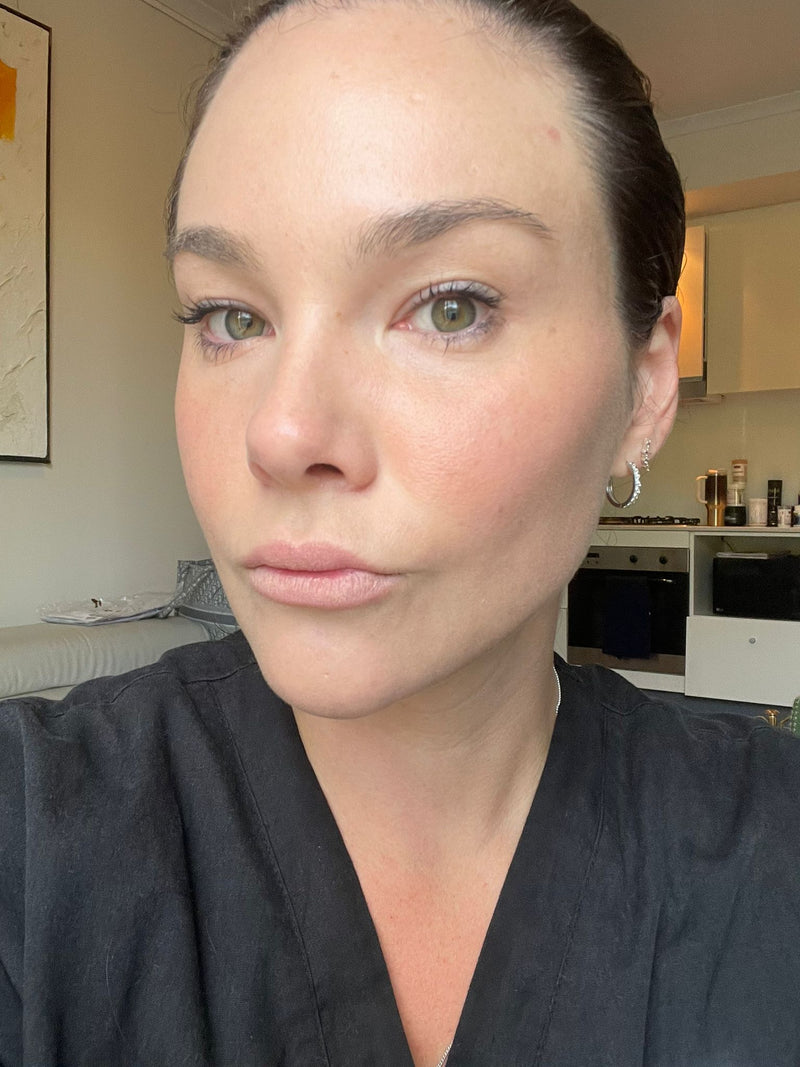 Six days after UltraClear 3DMIRACL treatment showing calmer brighter-looking skin