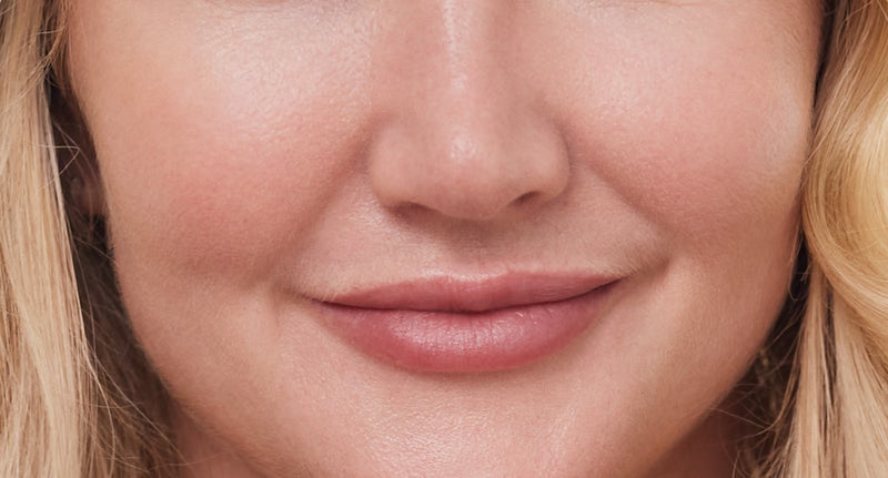 non surgical lip line treatment