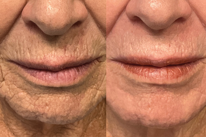 acne scar and wrinkle treatment with laser coring